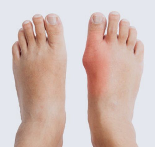 Bunions illustration