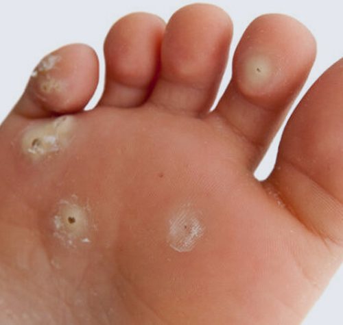 Calluses illustration