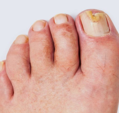 Fungal Infections illustration