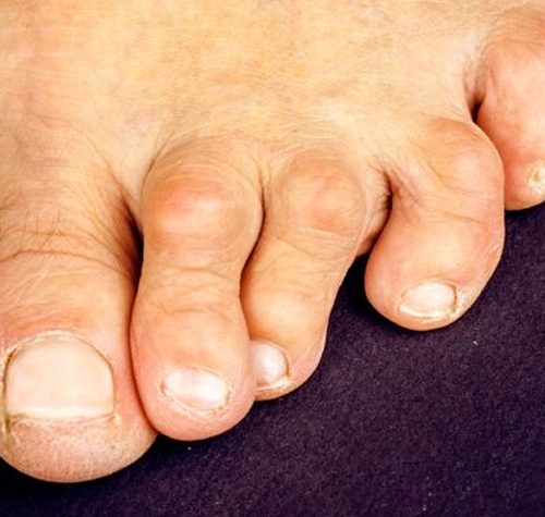 Hammertoes illustration