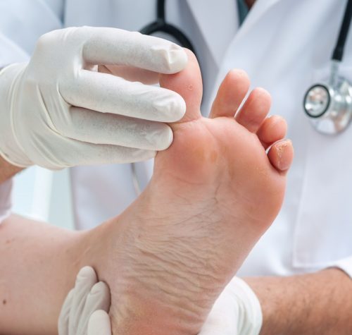 Ingrown Toenails illustration