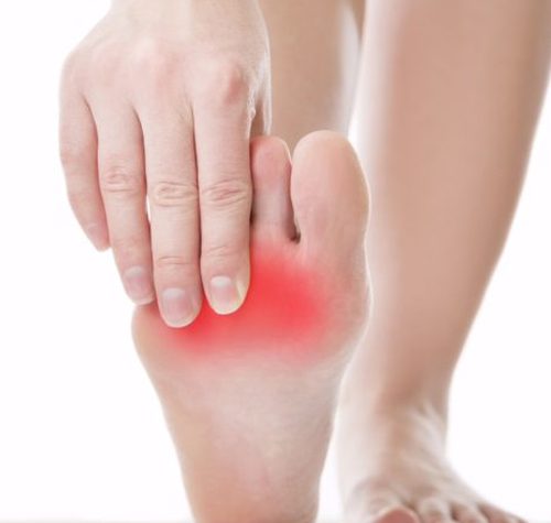 Neuromas illustration
