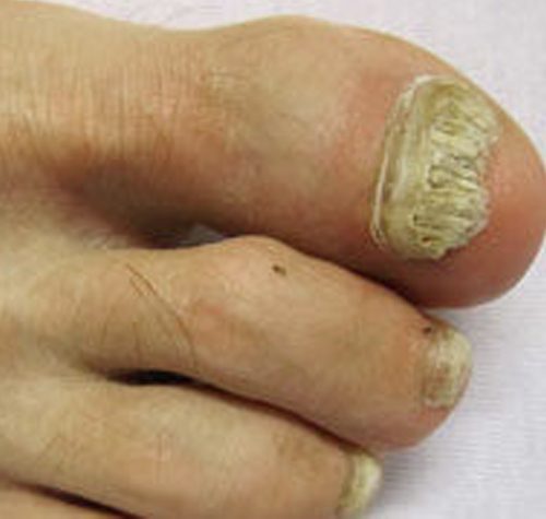 Onychomycosis illustration